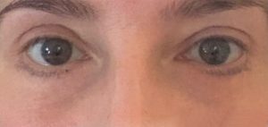Upper and lower eyelid reduction before and after, blepharoplasty befrore and after