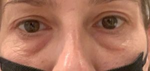 Upper and lower eyelid reduction before and after, blepharoplasty before and after