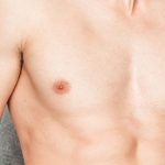 What is Gynecomastia