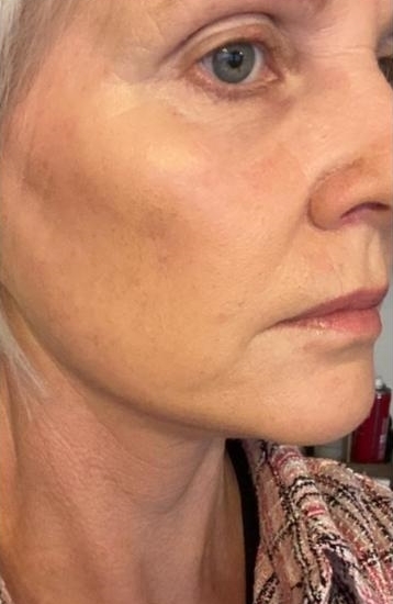 Facelift Before and After 2a