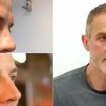 blepharoplasty-surgery-experience