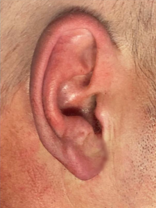 Earlobe reduction before and aftre 2, cosmetic surgery, pinnaplasty, signature clinic