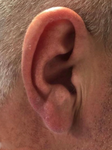 Earlobe reduction before and aftre, cosmetic surgery, pinnaplasty, signature clinic