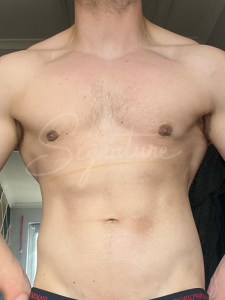 Gynecomastia-After, cosmetic surgery, signature clinic