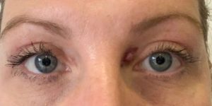 blepharoplasty before and after- signature clinic 3