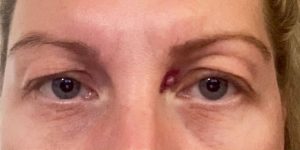 blepharoplasty before and after- signature clinic 2