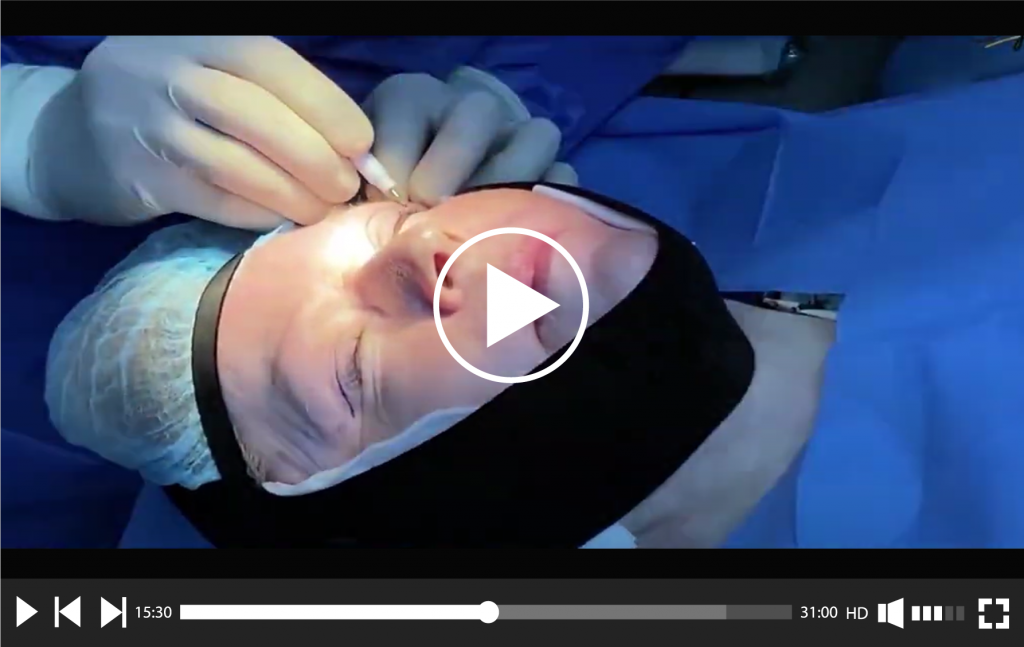 upper and lower Blepharoplasty surgery video