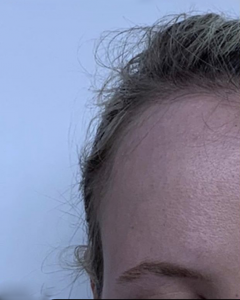 Forehead reduction before and after 010b