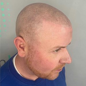scalp micropigmentation before after, micropigmentation, hair pigmentation