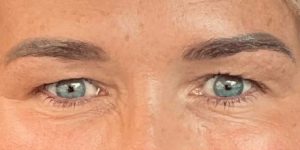 Dr. Carlo Debas, blepharoplasty before and after 2a