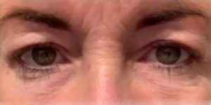 Dr. Carlo Debas, blepharoplasty before and after 3a
