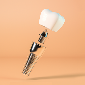 Dental Implants, cosmetic dentistry, signature clinic, TN1