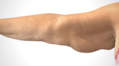 A woman's arm from wrist to shoulder, Arm lift, Armlift surgery, arm lift uk, arm lift London, arm lift signature