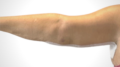 A woman's arm from wrist to shoulder, Arm lift, Armlift surgery, arm lift uk, arm lift london, arm lift signature