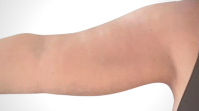 A woman's arm from wrist to shoulder, Arm lift, Armlift surgery, arm lift uk, arm lift London, arm lift signature