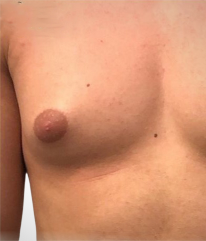 another side on male chest with gynecomastia