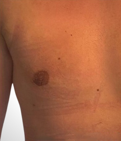 Another side on flat male chest after gynecomastia procedure