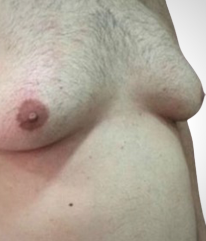 side on male chest with gynecomastia