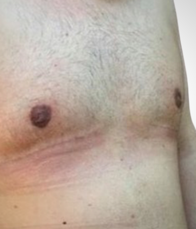 side on flat male chest after gynecomastia procedure