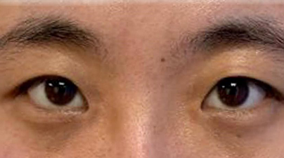 Close up of an Asian woman's eyes before a blepharoplasty treatment
