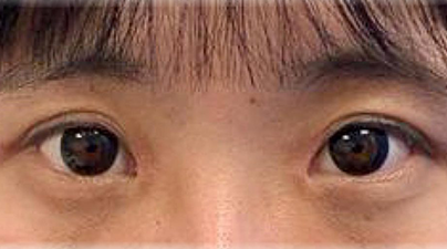 Blepharoplasty, asian blepharoplasty, Double eyelid surgery