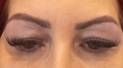 Close up of woman's eyes before a blepharoplasty treatment