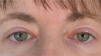 Close up of woman's eyes after a blepharoplasty treatment