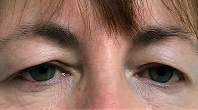 close up of woman's eyes before a blepharoplasty treatment