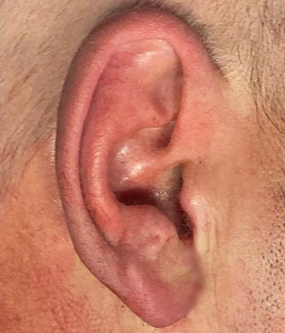 earlobe, earlobe repair, earlobe surgery, earlobe treatment