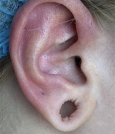 Earlobe repair is a simple and efficient cosmetic surgical treatment to treat split or stretched earlobes caused by the tearing of everyday earrings or stretched ears from piercing.