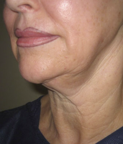 Patient side facing headshot before a facelift