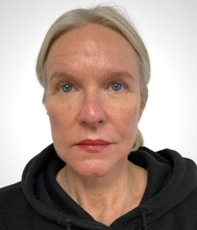 Patient front facing headshot after a facelift