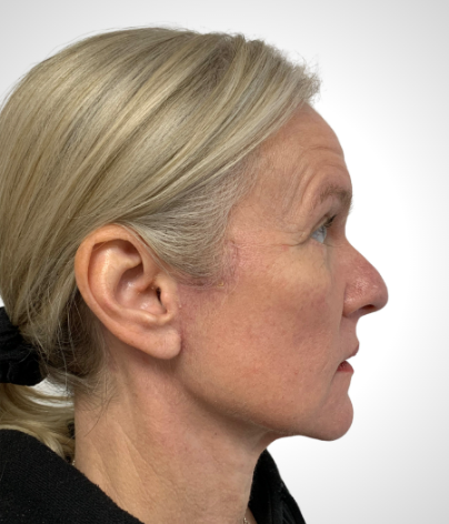 Patient side facing headshot after a facelift