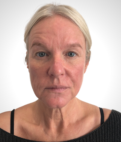 Patient front facing headshot before a facelift