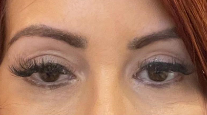 Close up of woman's eyes after a blepharoplasty treatment