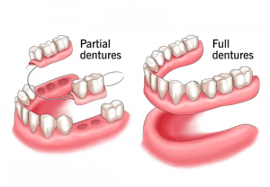 Dentures, Dentist, Partial dentures, full dentures