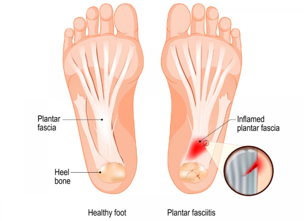 How to deal with issues with the sesamoid bone in the Foot