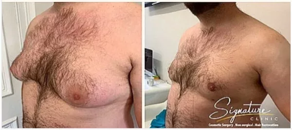 Life-Changing Impact of Gynecomastia Surgery