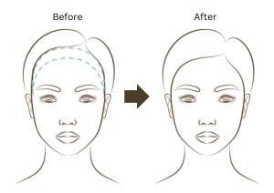 Forehead reduction
