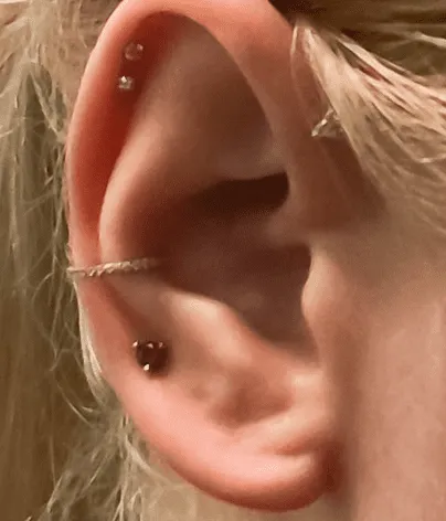 Earlobe repair after