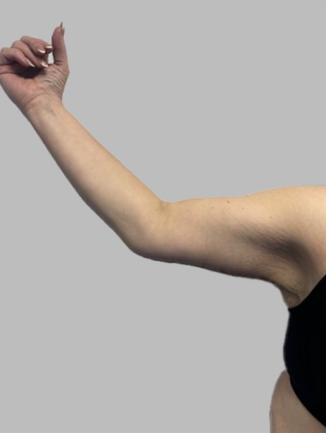 Arm Lift (Brachioplasty)