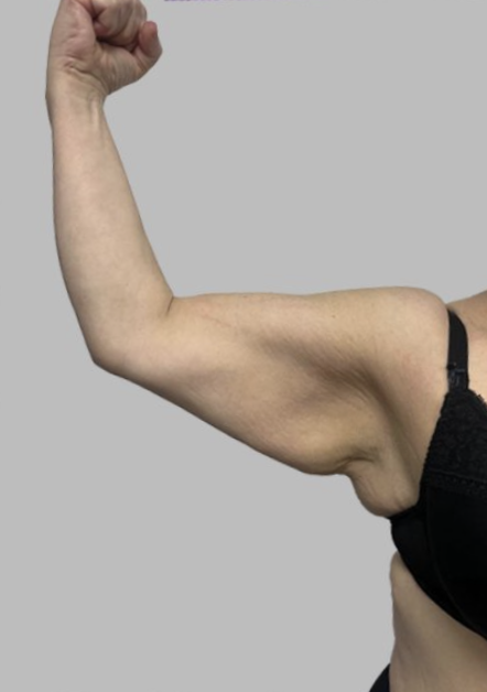 Arm Lift (Brachioplasty)