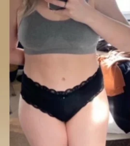 vaser liposuction before