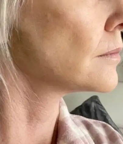 face and neck lift after