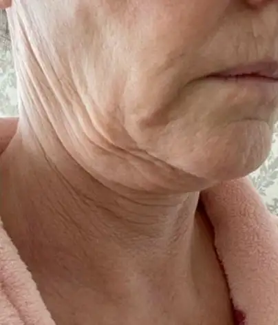 face and neck lift after