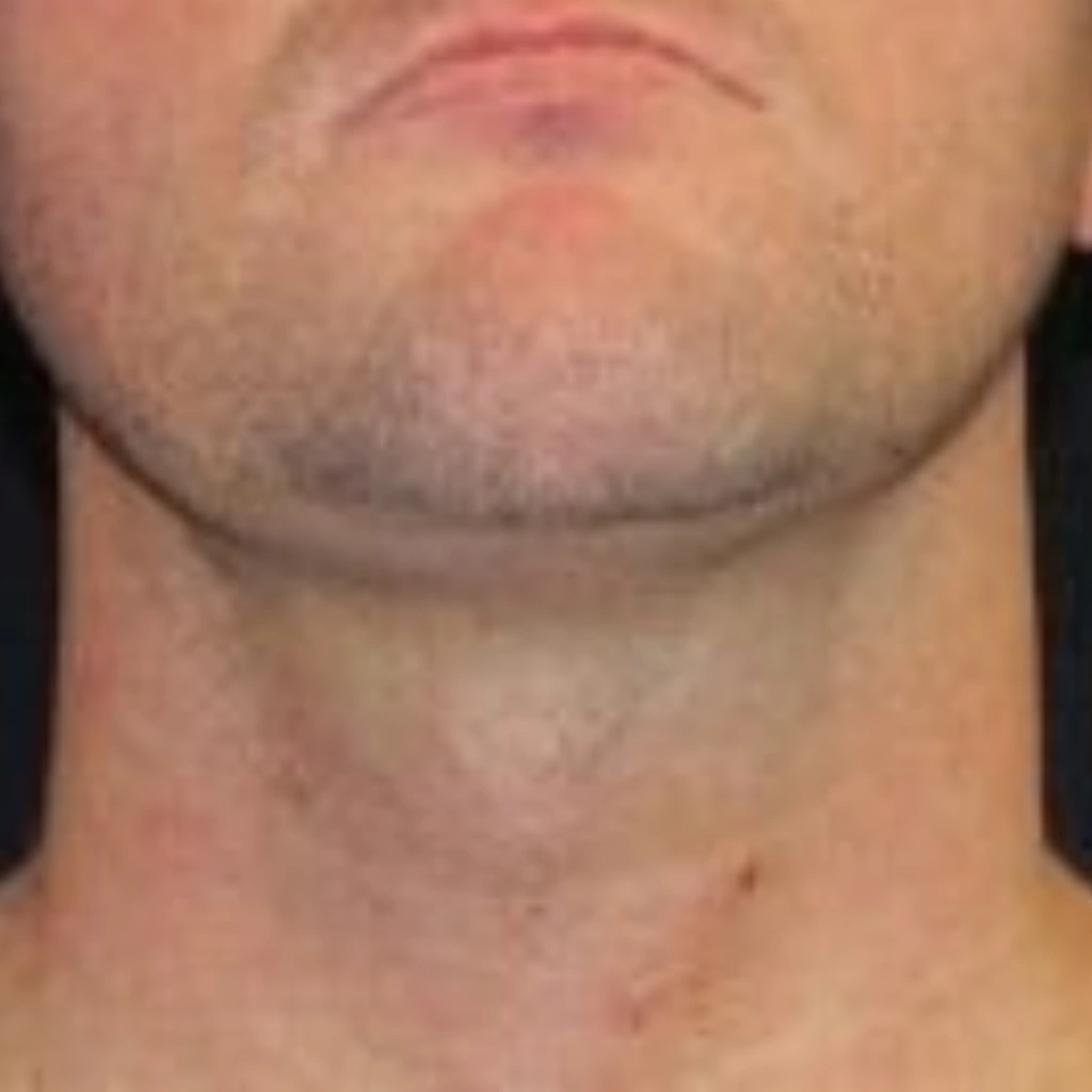 Double Chin Reduction