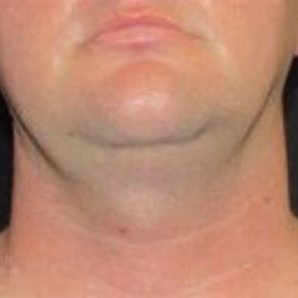 Double Chin Reduction