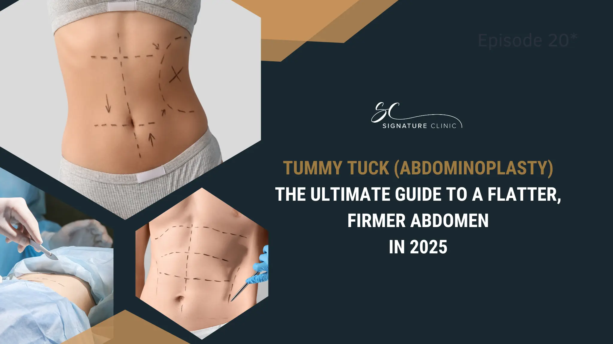 Tummy tuck