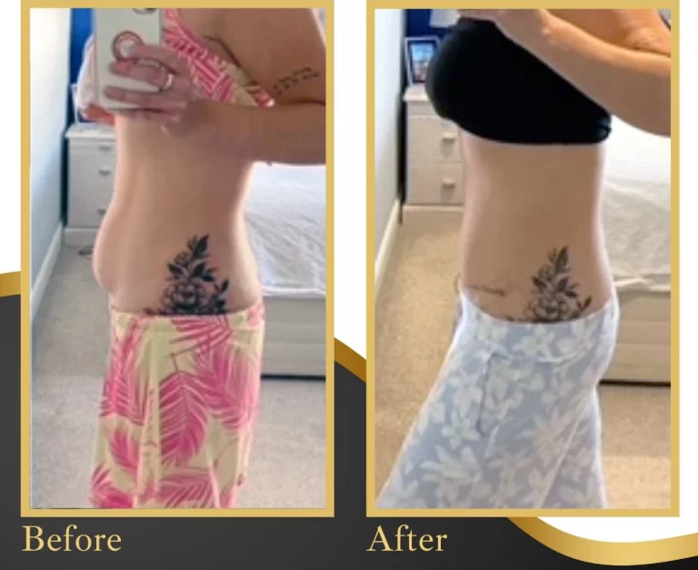 Tummy Tuck Before After