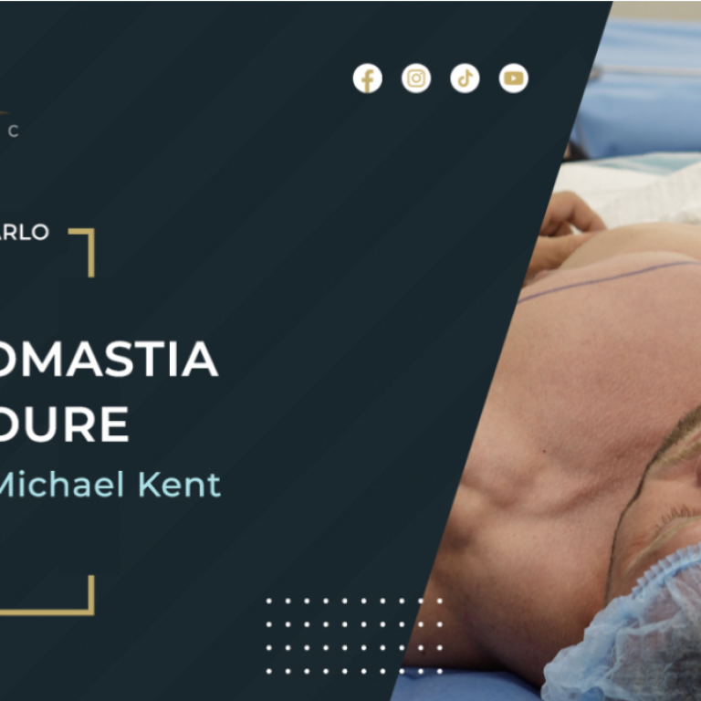 Unveiling Confidence: How UK Bodybuilding Champion Michael Kent Conquered Gynecomastia with Signature Clinic